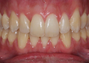 Invisalign Marlow After 3