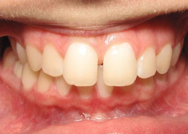 Invisalign Marlow Before 2