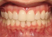 Invisalign Marlow After 2