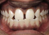 Invisalign Marlow Before 1
