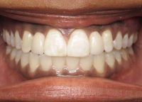 Invisalign Marlow After 2