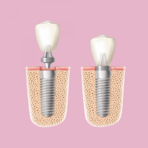 Marlow Dental Implants